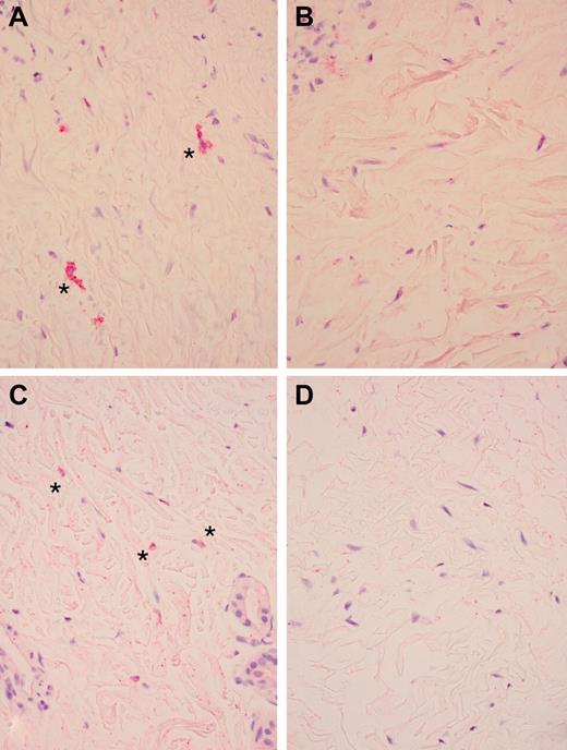 Figure 3. Pharmacodynamic effects of imatinib. *Antiphosphorylated PDGFRA staining (original magnification × 400) before (A) and after (B) imatinib treatment (patient 1) and *antiphosphorylated PDGFRB staining (original magnification × 400) before (C) and after (D) imatinib treatment (patient 11). Microscope: Olympus BX45; camera: Olympus DP25; acquisition software: CellSens Standard (Olympus).