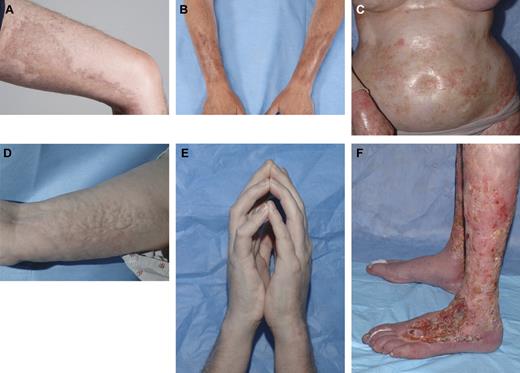 Figure 1. The spectrum of cutaneous findings in ScGVHD. Localized bound-down thickened hyperpigmented plaques on the thigh (A) and forearms (B) resemble morphea/localized scleroderma. Widespread shiny indurated skin on the torso resembles generalized systemic sclerosis and may lead to restricted chest wall expansion (C). Subcutaneous and fascial fibrosis results in an irregular, rippled appearance to the skin, resembling eosinophilic fasciitis (D) and may result in joint contractures, including the prayer sign (E). Skin breakdown and poor wound healing is a complication of long-standing ScGVHD, particularly of the lower extremities, and may lead to increased risk of systemic infection (F).