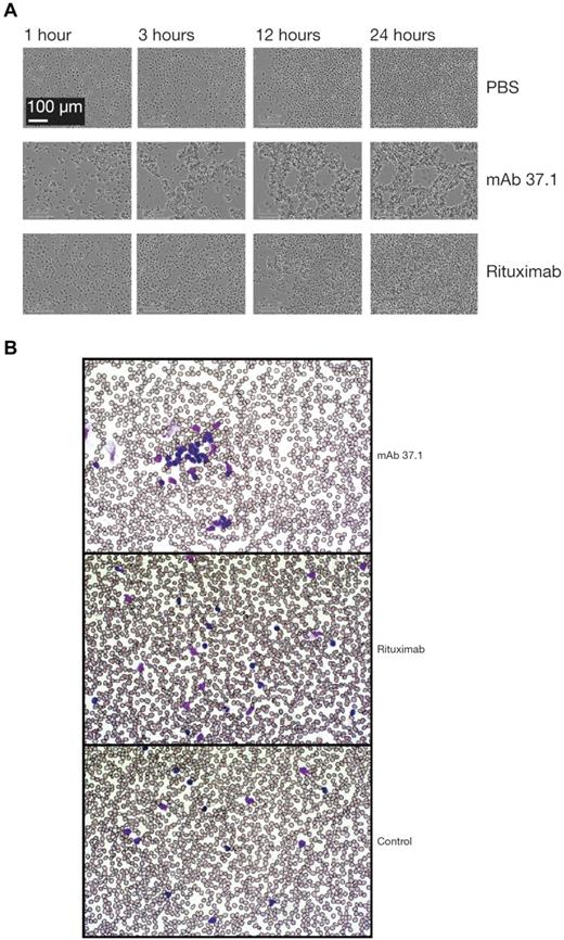 Figure 2. Phenotypic analysis. Phenotypic analysis of Ab treatment on Ramos cells (A) and primary CLL cells (B). Ramos cells were incubated with mAb 37.1 or rituximab at a concentration of 30 μg/mL in Image Lock microplates (Essen Instruments) at 37°C in cell culture medium and photomicrographs were recorded as JPEG files at the indicated time points using an automated live-cell imaging system (IncuCyte, Essen Instruments) equipped with a 20× phase-contrast objective. Blood samples from CLL patients were incubated with mAb 37.1 and rituximab for 1 hour and blood smears were analyzed after routine staining (Giemsa). Pictures were taken at room temperature using a Zeiss Axioskop microscope equipped with a 50× Neofluar objective and recorded by a Zeiss AxioCam MR5c without image processing.