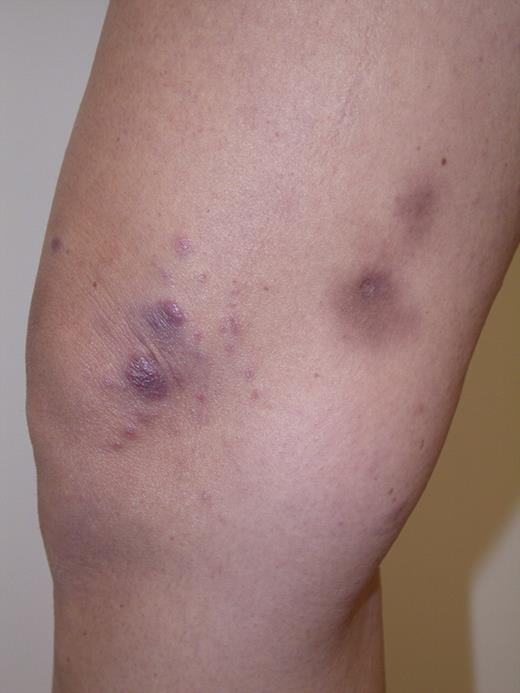 Figure 1. LYP: Grouped papules in the knee region. Note scars and hyperpigmentation as residual changes after spontaneous regression of the lesions. Clinical image was captured using a digital camera (Nikon Coolpix 995; Nikon).