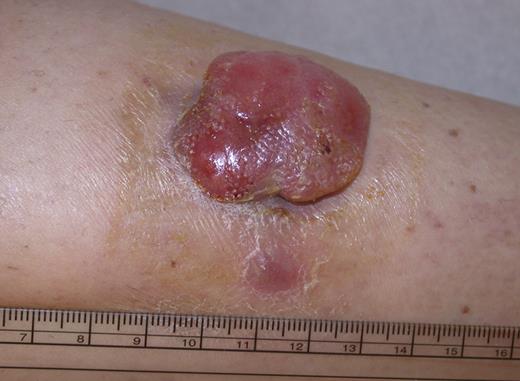 Figure 2. PCALCL: Solitary ulcerated nodule on the leg. Clinical image was captured using a digital camera (Nikon Coolpix 995; Nikon).