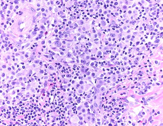 Figure 3. LYP: Large pleomorphic and anaplastic tumor cells intermingled with small lymphocytes, eosinophils, and histiocytes (hematoxylin and eosin, original magnification ×200). Histologic photomicrograph was captured using a digital camera (AxioCam MRc5; Zeiss) mounted on an Olympus microscope (BX45; Olympus). Objective lens: 400×/0.75 NA. Imaging software: Axio Vision Release 4.8.2 (Zeiss) and Adobe Photoshop Version 8.0 (Adobe Systems).
