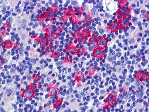 Figure 4. LYP: Expression of CD30 by scattered and clustered pleomorphic tumor cells. Histologic photomicrograph was captured using a digital camera (AxioCam MRc5; Zeiss) mounted on an Olympus microscope (BX45; Olympus). Objective lens: 400×/0.75 NA. Imaging software: Axio Vision Release 4.8.2 (Zeiss) and Adobe Photoshop Version 8.0 (Adobe Systems).