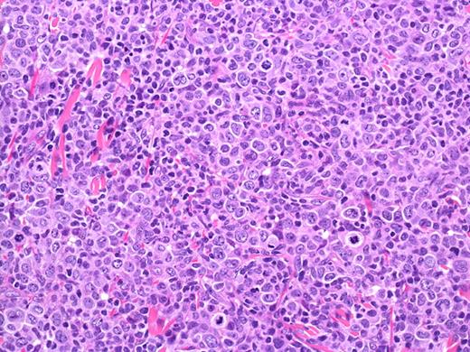 Figure 5. PCALCL: Cohesive sheets of anaplastic lymphoid cells H&E, original magnification ×200). The histologic photomicrograph was captured using a digital camera (AxioCam MRc5; Zeiss) mounted on an Olympus microscope (BX45; Olympus). Objective lens: 400×/0.75 NA. Imaging software: Axio Vision Release 4.8.2 (Zeiss) and Adobe Photoshop Version 8.0 (Adobe Systems Inc).