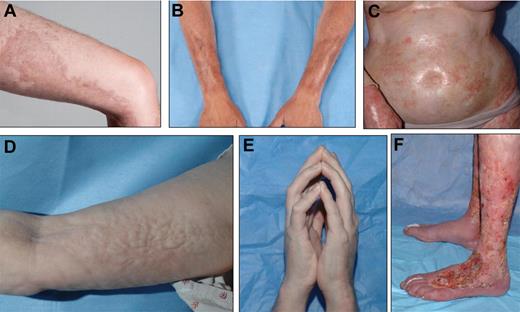 Localized, bound-down, thickened, hyperpigmented plaques on the thigh (A) and forearms (B) resemble morphea/localized scleroderma. (C) Widespread shiny indurated skin on the torso resembles generalized systemic sclerosis and may lead to restricted chest wall expansion. Subcutaneous and fascial fibrosis results in an irregular, rippled appearance to the skin, resembling eosinophilic fasciitis (D) and may result in joint contractures, including the prayer sign (E). (F) Skin breakdown and poor wound healing is a complication of long-standing ScGVHD, particularly of the lower extremities, and may lead to increased risk of systemic infection. See the complete article by Martires et al on page 4250.