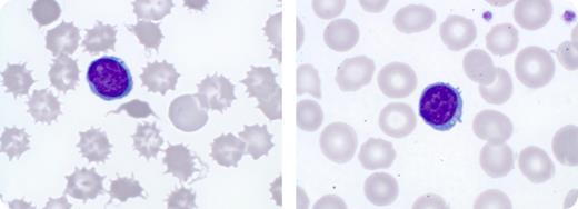 A 34-year-old patient with end-stage alcoholic liver cirrhosis became increasingly anemic and transfusion-dependent. On admission, he had a Coombs negative hemolytic anemia and a blood smear that showed marked poikilocytosis with numerous spiculated red blood cells (shown, left). / A diagnosis of spur cell anemia was made. Spur cell anemia is found in end-stage alcoholic liver disease. The morphologic changes of spur cells are caused by accumulation of excess membrane cholesterol, leading to an impaired deformability and consequently a reduced red cell survival. The prognosis of patients with spur cell anemia is poor, with a median survival of a few months. Liver transplantation represents the only potentially curative option. / The patient underwent liver transplantation but experienced primary graft failure with consecutive need for urgent retransplantation. Within 3 months after the second liver transplantation, spur cells had disappeared (shown, right) with a sustained improvement of the anemia and transfusion independence. Currently, 12 months after alcohol cessation and 6 months after transplantation, the patient is doing well with normal peripheral blood values.