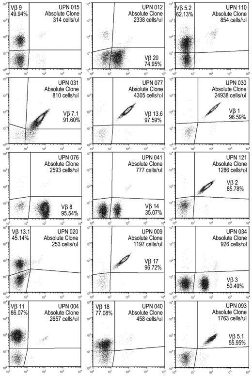 Figure 1. Vβ expansions can dominate the CD8 TCR repertoire and are effectively detected by flow cytometry via fluorescently labeled monoclonal antibodies against specific variable β regions. Representative flow plots of LGL patients gated on lymphocytes that are CD3+CD8+, each panel is 1 patient identified by a unique patient number (UPN). Plots may represent other measurements than baseline for each patient.