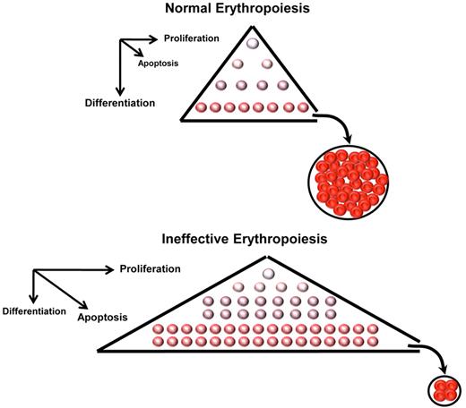 Figure 3. Schematic representation of normal and ineffective erythropoiesis. In normal conditions, erythroblasts generate erythrocytes through a homeostatic balance between proliferation, differentiation, and cell death. In ineffective erythropoiesis, formation of toxic hemichromes leads to apoptosis and cell death of many erythroid precursors, limiting production of erythrocytes. Furthermore, on the basis of several observations (as discussed in the text), we postulate that in β-thalassemia erythroid precursors increase cell proliferation concurrently with reduced cell differentiation. This leads to a net increase in the number of erythroid precursors despite higher rates of apoptosis.