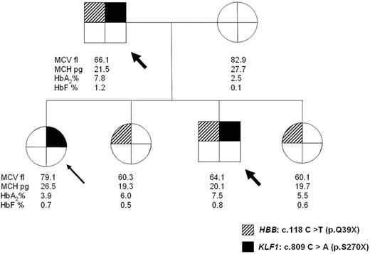 Figure 1. Pedigree of a family showing independent segregation of heterozygous β-thalassemia and KLF1 mutation. The arrow indicates the proband: head-arrows indicate double heterozygotes for HBB and KLF1 mutations who have outlier levels of HbA2.