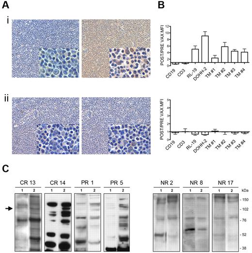 Figure 1. Antitumor cross-reactivity of vaccine-induced Igs in responders. (A) Representative IHC evaluations of biotin-conjugated pre- (left) and postvaccination (right) Igs from responder 14 (i) and nonresponder 2 (ii) tested on allogeneic human FL specimens. Digital images were acquired with Nikon DN100 digital net camera and the Nikon Eclipse E400 microscope, and processed using Photoshop CS4 software version for Macintosh Pro personal computer. Original magnifications: panels, ×10; insets, ×40. (B) Flow cytometry of normal B (CD19) and T (CD3) cells, NHL cell lines (RL-19 and DOHH-2), and 4 different primary FLs (TM 1-4) using biotin-conjugated Igs from responders (top) and nonresponders (bottom) and FITC-labeled streptavidin as revealing system. Results are represented as the ratio between MFI of post- and prevaccination samples. Data are mean ± SE of 4 independent experiments. (C) WB analyses of DOHH-2 whole lysate probed with biotin-conjugated Igs purified from pre- (lanes 1) and post- (lanes 2) vaccination serum from responders 13, 14, 1, and 5 (left) and nonresponders 2, 8, and 17 (right). Arrow indicates the differentially revealed proteins. CR indicates complete responder; and PR, partial responder.