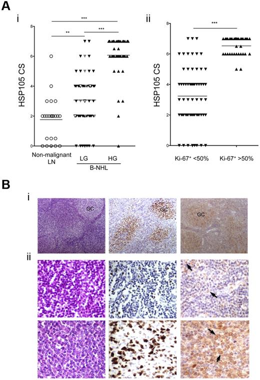 Figure 4. Immunohistochemistry of HSP105 expression in normal and neoplastic lymph nodes. (A) HSP105 expression levels measured by IHC using the defined CS in B-NHLs (97 cases) and nonmalignant lymph nodes (26 cases) plotted against tumor aggressiveness based on lymphoma histologic grade (i) or Ki-67 expression levels (ii). HSP105 CS in tumor biopsies from vaccinated patients is highlighted (white represents responders; and gray, nonresponders). The lines indicate the median values. Significant differences of HSP105 expression between groups were calculated with the unpaired 2-tailed Student t test: **P ≤ .01; ***P ≤ .001. Correlation between HSP105 expression and lymphoma aggressiveness was determined with the Spearman rank correlation test. LN indicates lymph nodes; HG, high grade; and LG, low grade. (B) Representative IHC analyses of low- and high-grade B-NHLs, using streptavidin-biotin-HRP complex method with 3-3′ diaminobenzidine as a chromogen (brown signal). Hematoxylin and eosin (left), Ki-67 (middle), and HSP105 (right) staining in one case of FL (i) and lymphoplasmocytic lymphoma (ii) before (top) and after progression (bottom) toward a DLBCL. Arrows indicate HSP105 expression on lymphoma cell surface. Digital images were acquired with Nikon DN100 digital net camera and the Nikon Eclipse E400 microscope, and processed using Photoshop CS4 software version for Macintosh Pro personal computer. Original magnifications: Bi, ×10; and Bii, ×20.