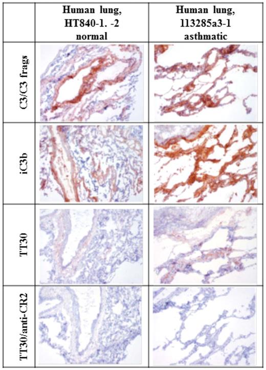 Figure 6. Staining for iC3b and C3/C3 fragments in inflamed and normal human lung. Left column. Lung from control “normal” human (HT840-1, -2). 10×. Staining for iC3b and C3/C3 fragments in normal human lung tissue was characterized by weak to strong staining of frequent intravascular, interstitial, and perivascular extracellular proteinaceous material, as well as peribronchiolar interstitium and/or alveolar septae. This is consistent with the spontaneous tickover of CAP activity and with normal methods of inactivating C3b to iC3b. Staining for C3/C3 fragments was more intense than staining for iC3b. Staining with TT30 is less intense (likely because of differences in concentration and signal amplification, as well as binding avidity) but follows the same pattern as for iC3b and C3/C3 fragments. TT30 staining is blocked by inclusion of an anti-CR2 mAb. Right column. Inflamed lung from asthmatic human (113285a3-1). 10×. Staining for iC3b and C3/C3 fragments in peribronchiolar interstitium and/or alveolar septa is of greater intensity and extends further into smaller airways than in the normal lung. Staining with TT30 is more intense and more broadly distributed, after the iC3b and C3/C3 fragment staining patterns. This is consistent with the targeting of TT30 to sites of C3 fragment deposition by binding of the CR2 portion. This binding is blocked by addition of an anti-CR2 mAb.