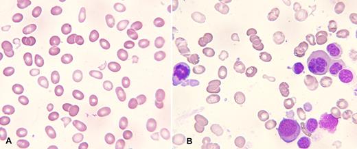 A 67-year-old man with polycythemia vera on hydroxyurea for 4 years presented with an abrupt pancytopenia requiring admission and transfusion support. His CBC revealed WBC 2.3 × 109/L, neutrophils 1.2 × 109/L, hemoglobin 62 g/L, MCV 94 fL, and platelets 16 × 109/L. The reticulocyte count was < 1 × 109/L, LDH and bilirubin were slightly elevated, and coagulation tests were normal. / On the peripheral blood film, there was a moderate degree of red cell fragmentation (panel A) with ovalocytes, teardrop cells, and a near absence of neutrophils and platelets. A bone marrow aspirate (panel B) and biopsy were obtained. The incidence of myeloblasts was < 5% by both morphologic and flow cytometric evaluation. Morphologic examination of the aspirate demonstrated marked dyserythropoiesis with red cell fragments in the background (panel B). Bone marrow cytogenetic karyotyping revealed deletions in 5q, 7q, and 20q. A diagnosis of myelodysplastic syndrome, refractory cytopenia with multilineage dysplasia (RCMD), was made with intermediate-2 score on the International Prognostic Scoring System (IPSS). / This case illustrates the development of myelodysplastic syndrome from previous polycythemia vera that was detected by marked pancytopenia and peripheral blood smear abnormalities that included red cell fragmentation.