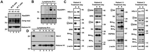 Figure 2. Evaluation of potential markers of drug effect in samples from this trial. (A) CD19+ cells (lanes 1 and 2) and CD3+ cells from 2 normal (Nl) persons were probed with antibodies to RasGRP1 and, as a loading control, histone H1. (B) Example of RasGRP1 blotting in 4 lymphoma samples. β-actin served as a loading control. Nonadjacent lanes from a single blot have been juxtaposed to assemble this panel. (C) Effect of tipifarnib on signaling and Bim expression in situ. Each blot is a separate patient with pre- and post-tipifarnib results. In patients 5 (MCL) and 11 (small lymphocytic lymphoma), circulating tumor cells were examined; in patients 3 and 6 (both large cell), paired lymph node samples were assayed. The HDJ-2 shift after treatment (patients 3 and 5) confirms tipifarnib-induced inhibition of FT. Effects on ERK phosphorylation were variable, with decreases in patients 5 and 6 but an increase in patient 3. Some or all Bim isoforms increased in patients 5, 6, and 11 with a smaller increase in patient 3. (D) Examples of pretreatment Bcl-2 levels.
