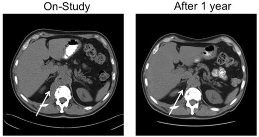 Figure 3. A 67-year-old man with stage IVA diffuse large B-cell lymphoma. He was treated with rituximab, cyclophosphamide, vincristine and prednisone × 6 with an initial complete response, only to relapse 7 months later. He responded to salvage chemotherapy and received an autologous stem cell transplantation with a 6-month TTP. After failing single-agent rituximab, he joined this study. He responded to tipifarnib 300 mg twice daily. Because of myelosuppression, the dose was reduced to 100 mg twice daily. He maintained remission for 25 months before progressing on therapy. Tumor biopsies before and after tipifarnib demonstrated low bcl-2 protein tumor content at baseline with a marked increase in Bim isoforms and decrease in p-ERK after tipifarnib (patient 6; Figure 2C).