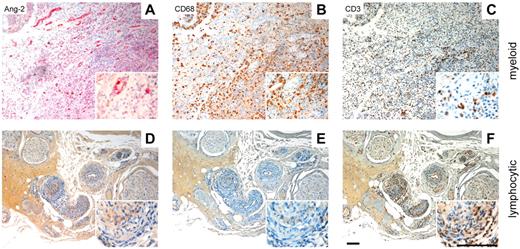 Figure 1. Ang-2 expression is strongly associated with myeloid cell infiltration. Tissue sections derived from human inflammatory diseases were separated into myeloid dominated (A-C, abscess with granulation tissue) and lymphocyte dominated specimen (D-F, vasculitis/peripheral nerve). Specimen with high numbers of CD68+ macrophages (B) and low numbers of CD3+ T cells (C) show strong vascular staining for Ang-2 (A). In contrast, specimens with high numbers of infiltrating T cells (F) and low numbers of macrophages (E) were negative for Ang-2 (D). Scale bar represents 100 μm.