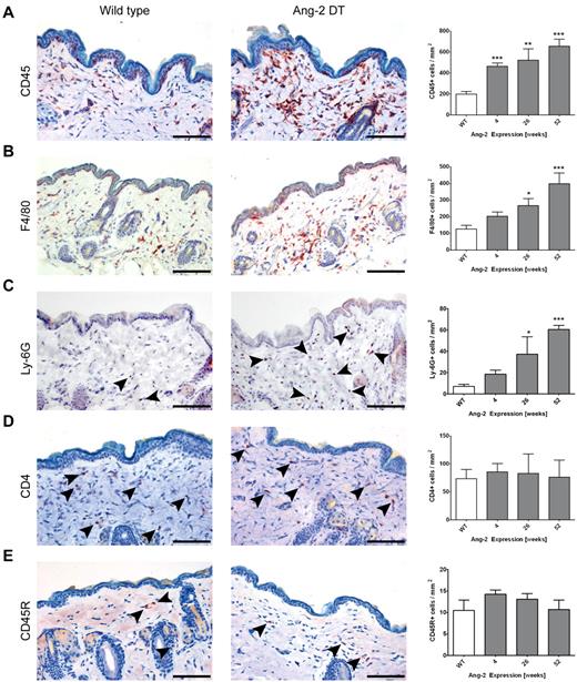 Figure 5. Ang-2 induced skin infiltration of macrophages. Immunostaining of WT and Ang-2 transgenic skin sections using various leukocyte markers. Representative images after 52 weeks of transgene expression are displayed, and the number of CD45+, F4/80+, Ly-6G+, CD4+, and CD45R+ B cells per millimeter squared were determined. CD45+ leukocytes accumulate progressively on prolonged Ang-2 expression (A). Among these, F4/80+ macrophages (B) and Ly-6G+ neutrophil granulocytes (C) are enriched, whereas CD4+ T cells and CD45R+ B cells compose only a minor fraction (indicated by arrowheads) that remains constant over time (C-D). Data are mean ± SEM of 5 animals. P values represent significance over WT cell count. Scale bar represents 100 μm. *P < .05. **P < .01. ***P < .005.