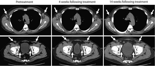 Figure 3. Marked reduction of peripheral lymphadenopathy was observed after treatment with autologous 19-28z+ T cells. Representative computed tomography scan images of patient CLL-5 before treatment and from 4 weeks and 14 weeks after treatment show mild increase in axillary (top) and pelvic lymphadenopathy (bottom) at 4 weeks but regression of lymphadenopathy at 14 weeks after therapy with modified T cells.