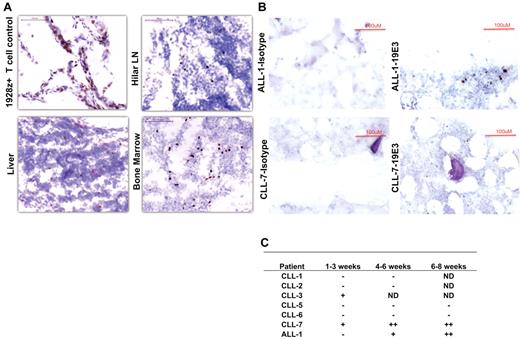 Figure 5. Immunohistochemistry staining of tissues with 19E3 anti-CAR Ab. (A) Trafficking of targeted T cells to tumor sites in CLL-4 44 hours after T-cell infusion. Images were acquired at room temperature using Nikon 90i Eclipse microscope system (Nikon) with a Nikon Plan Apo VC 20×/0.75 objective lens (magnification 200×), Nikon DigiSight Digital Camera Head and Nikon NSI-Elements Version 3.10 software. (B) Trafficking and homing of targeted T cells to BM. IHC staining on BM biopsies shows the presence of 19-28z+ T cells 5 and 6 weeks after infusion in patients ALL-1 and CLL-7, respectively (C) Trafficking and homing of targeted T cells to BM ≤ 8 weeks after infusion. ND indicates not done; (−) no positive 19-28z+ T cells found; (+) positive 19-28z+ T cells found occasionally, and (++) positive 19-28z+ T cells readily identifiable.
