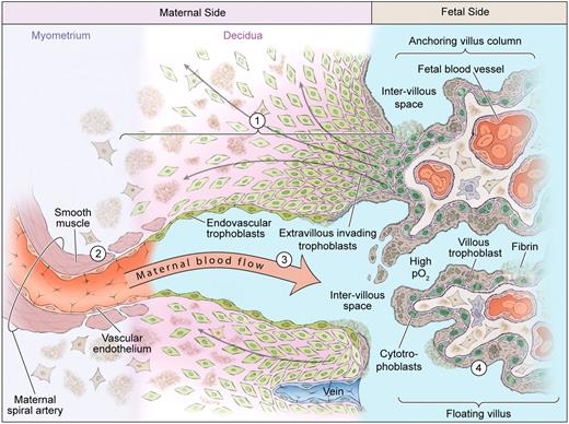 Figure 1. Normal placental development. Extravillous cytotrophoblasts proliferate in anchoring columns to successful invade through the decidua (1) and transform the distal spiral arteries (2). These changes mediate high volume flow at low pressure into the intervillous space (3). The placental villi are covered by the villous trophoblast compartment (4), comprising cytotrophoblasts that proliferate to generate the outer syncytiotrophoblast in direct contact with maternal blood.