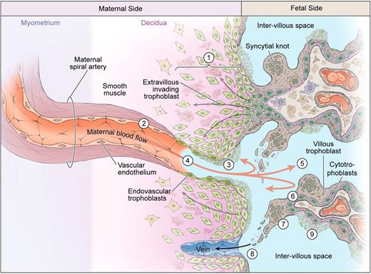Figure 2. Uteroplacental vascular insufficiency. Extravillous cytotrophoblasts are less successful in invading the maternal decidua and may be removed by the maternal immune system (1). Consequently the distal spiral arteries are narrower (2) and diseased, accompanied by atherosis or local fibrin deposition (3) and reduced endovascular invasion (4). Hypoxia or hypoxia-reoxygenation injury (5) has direct effects on the villous trophoblast compartment, reducing syncytial fusion (6) that may trigger the formation of syncytial knots (7). These accumulate but may fragment and shed into maternal blood (8), whereas areas deficient in syncytial fusion may exhibit focal necrosis (9).