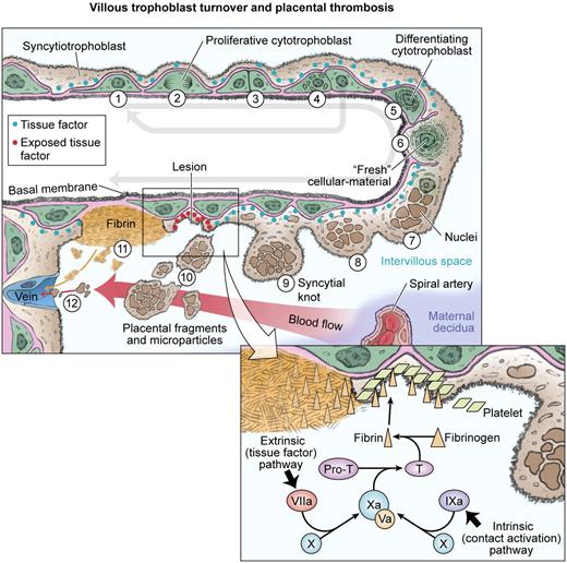 Figure 3. Abnormal villus trophoblast differentiation and placental thrombosis. Progenitor cytotrophoblasts proliferate (1) and divide asymmetrically (2 and 3) so that the progenitor is conserved (4) for subsequent rounds of syncytial fusion. The daughter cytotrophoblast prepares for syncytial fusion (5), focally donating transcriptional machinery and antiapoptotic proteins into the outer syncytiotrophoblast (6). Syncytial nuclei gradually progress toward apoptosis and aggregate in syncytial knots (7 and 8). Syncytial fusion is restricted in severe PE, increasing the number and size of syncytial knots (9 and 10). Some knots may fragment into the intervillous space, whereas other parts of the abnormal villi have exposed cytotrophoblasts and basal lamina (11) that trigger local thrombosis (see inset). Syncytiotrophoblast fragments are filtered in the maternal lungs, whereas microparticles pass through and may exert systemic effects in the maternal vasculature.