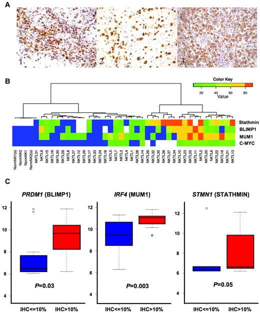 Figure 4. Expression of protein targets of deregulated miRNA. (A) IHC showing overexpression of (i) BLIMP1, (ii) MUM1, and (iii) STATHMIN in the tumor cells. BLIMP1 and MUM1 are expressed in the nuclei, whereas STATHMIN is expressed in the cytoplasm of the neoplastic lymphoid cells. All photographs were taken with a DP20 Olympus camera (Olympus) using an Olympus BX41 microscope (Olympus); images were acquired using DP Controller 2002 (Olympus) and processed using Adobe Photoshop Version 7.0 (Adobe Systems). Original magnifications ×600. (B) The percentage of tumor cells staining for the different protein markers are represented in the form of a heat map. The color scale corresponding to the percentage of positive staining cells is appended in the left upper corner. Samples with results represented by white indicate that the stain was not done because of inadequate material. Cases with the highest expression of STATHMIN, MUM1, and BLIMP1 also have the highest expression of MYC. (C) The expression of mRNA corresponding to these proteins was higher in those samples where > 10% of tumor cells are staining positive for each protein marker. For BLIMP1 and MUM1, it is statistically significant.