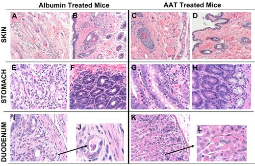 Figure 6. Skin, stomach, and duodenal histology in AAT-treated and albumin-treated C57/BL6J mice transplanted from C3H.SW-H2b/SnJ donors. Mice were sacrificed on day 21 after transplantation (3 mice per group). Tissues were placed in 10% formalin, embedded in paraffin, sectioned, stained with H&E, and analyzed. Slides were imaged on an Axio Observer inverted microscope (Carl Zeiss MicroImaging) and captured with an Axiocam MRm camera (Carl Zeiss MicroImaging). (A) Skin section of albumin-treated mouse showing edema with interstitial inflammation (10×). (B) Skin section of albumin-treated mouse showing interstitial fibrosis and inflammation invading and damaging hair follicles, characteristic of GVHD (10× lens). (C-D) Skin of 2 AAT-treated mice showing normal histology (10× and 4×, respectively). (E) Stomach of albumin-treated mouse showing interstitial gastritis and evidence of GVHD. (F) Stomach of albumin-treated mouse showing interstitial gastritis and evidence of GVHD with tissue edema and lymphocytic infiltration. (G) Forestomach of AAT-treated mouse showing minimal evidence of GVHD (10×). (H) Stomach of AAT-treated mouse showing normal histology. (I-J) Glandular forestomach/duodenum of albumin-treated mouse showing interstitial inflammation, crypt loss, and apoptotic bodies with 1 small crypt abscess, typical for GVHD (4× and 10×). (K-L) Duodenum of AAT-treated mouse with minimal focal evidence of GVHD (4× and 10×).