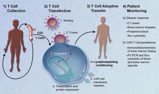 Schematic of the treatment of a patient with chimeric antigen receptor (CAR) T cells. (1) Isolation of peripheral T cells from patient via apheresis. (2) Transfection of T cells with a lentivirus containing genes for CAR directed against the tumor target antigen: binding of virus to T-cell membrane, fusion of virus with cell membrane, reverse transcription, DNA integration, and transcription/protein expression of CAR genes, and insertion of CAR into cell membrane. (3) Adoptive transfer of autologous CAR-T cells via infusion with or without prior lymphodepleting conditioning. (4) Patient monitoring for treatment response, and for persistence of CAR-T cells. Professional illustration by A. Y. Chen.