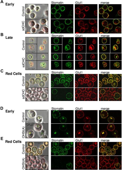 Figure 6. Confocal imaging of cultured erythroblasts. (A) Confocal imaging of cultured early stage sdCHC and control erythroblasts probed with anti-glut1 (red) and anti-stomatin (green). (B) Confocal imaging of cultured late-stage sdCHC and control reticulocytes probed with anti-glut1 (red) and anti-stomatin (green). (C) Confocal imaging of peripheral blood from sdCHC and control probed with anti-glut1 (red) and anti-stomatin (green). (D) Confocal images of cultured early-stage OHSt(A)3 erythroblasts probed with anti-glut1 (red) and anti-stomatin (green). (E) Confocal images of peripheral blood from OHSt(A)3 probed with anti-glut1 (red) and anti-stomatin (green).
