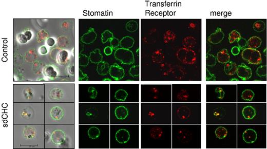 Figure 7. Colocalization of stomatin with endosomal marker CD71. Confocal imaging of cultured late-stage control and sdCHC reticulocytes probed with anti-stomatin (green) and anti-CD71 (transferrin receptor, red). The z-stack of sdCHC and control reticulocytes was examined, and the number of internal vesicles in which stomatin appeared, or TfR appeared, or in which the proteins colocalized, was noted. On average control reticulocytes contained 3 stomatin-positive vesicles per cell (n = 55 cells examined), whereas sdCHC reticulocytes contained 6 stomatin-positive vesicles per cell (n = 27 cells examined). In control cells ∼ 30% of the stomatin-positive vesicles colocalized with transferrin receptor. In sdCHC cells ∼ 60% of the stomatin-positive vesicles colocalized with transferrin receptor.