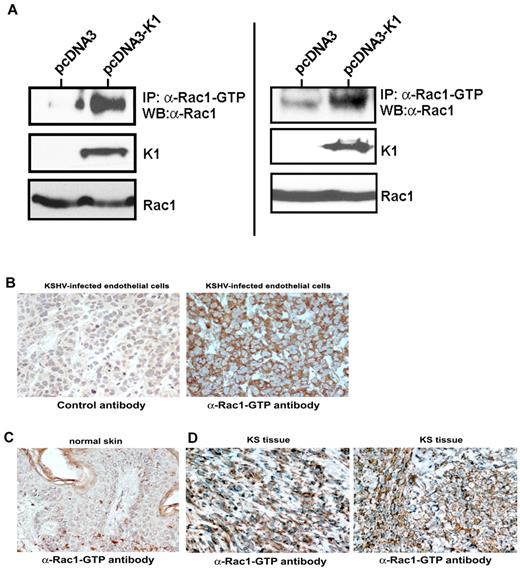 Figure 7. Rac1 is activated in K1-expressing cells and in KS tumors. (A) HEK293 cells were transfected with either pcDNA3 vector alone or pcDNA3-K1 and 48 hours after transfection, cells were harvested and subjected to immunoprecipitation with anti–Rac1-GTP antibody followed by Western blotting for Rac1. Two independent anti–Rac1-GTP immunoprecipitations from vector and K1-expressing cells are shown. Expression of K1 and Rac1 in these cells was verified by Western blot. (B) Immunohistochemistry showing active Rac1-GTP in tumor sections from mice injected with KSHV-infected endothelial cells. (C) Immunohistochemistry showing active Rac1-GTP in normal human skin sections. (D) Immunohistochemistry showing active Rac1-GTP in KS tumor tissue sections. No staining was observed in the presence of a control antibody (panel B). Original magnification, ×400.