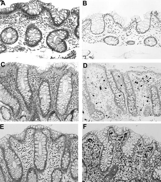 Figure 3. Histologic features of the rectal mucosa. (A) Rectal biopsy of patient P26 showing very mild lamina propria infiltration by lymphocytes and macrophages. (B) No MHC class II expression on inflammatory and epithelial cells. (C) Rectal biopsy of patient P14 revealing moderate lamina propria infiltration by lymphocytes, eosinophils, macrophages, and plasma cells. (D) Absence of MHC class II expression on inflammatory and epithelial cells. Only eosinophils are stained because of endogenous peroxidase activity. (E) Normal histologic appearance of a control rectal biopsy. (F) Normal expression of MHC class II on lamina propria cells in a rectal biopsy.