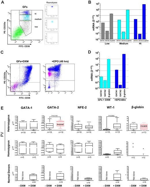 Figure 2. EBs generated ex vivo by MNCs of PV patients with or without dexamethasone express levels of GATA1, NF-E2, and WT1 similar to those expressed by EBs generated by MNCs from NDs with dexamethasone. Maturation profiles (by FACS analysis for CD36/CD235a expression; A,C) and gene expression profile (GATA1, GATA2, and β-globin; B,D) of EBs obtained from NDs in the presence of growth factors (GFs) without (A-B) or with (C-D) dexamethasone (DXM). Because of the great contamination from non-EBs (> 50%; Figure 1C and Table 1), EBs generated in the absence of DXM were purified by sorting into classes of progressively more mature populations on the basis of CD235a expression (CD235alow, CD235amedium, and CD235ahigh), and gene expression by individual populations was compared. Erythroblasts obtained in the presence of GFs plus DXM were analyzed before and after induction of maturation with erythropoietin (EPO) for 48 hours. Expression levels are expressed as 2−ΔCt and are presented as mean ± SD of at least 3 separate experiments. (E) Levels of GATA1, GATA2, NF-E2, WT1, and β-globin expressed by EBs generated by heterozygous (top panels) and homozygous (middle panels) PV patients and by NDs (bottom panels) with and without DXM. Because of the heterogeneity of their cell composition, samples from NDs cultured without DXM were not included in the analyses. Expression levels are presented as 2−ΔCt and as mean ± SD of different experiments. If differences were significant, P values are provided. Erythroblasts obtained from heterozygous PV patients with DXM expressed levels of GATA2 and β-globin significantly different from those expressed by EBs obtained from NDs with DXM and are indicated in red. The numbers of experiments included in each group are indicated by n.