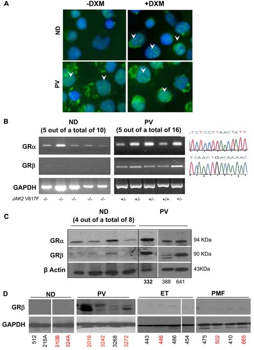 Figure 4. Constitutive nuclear localization of GR in EBs generated ex vivo from PV MNCs is associated with expression of the dominant negative GRβ isoform. (A) Immunostaining for GR of EBs obtained from 1 representative ND and PV patient with and without dexamethasone (DXM). Arrowheads indicate representative nuclear localization of GR. In EBs from ND, nuclear staining for GR was observed after DXM stimulation and had the punctuated appearance expected for GRα. By contrast, in EBs from PV, GR staining of the nucleus had a diffuse DXM-independent pattern characteristic of GRβ.40 Magnification ×40. (B) RT-PCR analyses for expression of GRα and GRβ of EBs expanded ex vivo from 5 representative ND and PV patients. The homozygous (+/+) or heterozygous (+/−) allele status of the JAK2V617F mutation of the PV patients is indicated on the bottom. Similar results were obtained with additional NDs (n = 5) and PV patients (n = 11; not shown). In all cases, the identity of the band was confirmed by sequencing (on the right). GAPDH was amplified as control. (C) WB analyses with GRα- and GRβ-specific antibodies of EBs generated from 8 additional NDs (not analyzed at the mRNA level) and from 3 PV patients (the first patient was analyzed at the mRNA level in the second lane in panel B). β-actin was analyzed as a loading control. The proteins recognized by the GRα- and GRβ-specific antibodies migrated with an apparent molecular weight of 94 and 90 kDa, respectively. (D) WB analyses for GRβ of MNCs from NDs and from PV, ET, and PMF patients (4 each). Data are representative of those observed in a total of 10 subjects per group. In panels C and D, ND and MPN patients are identified by the same unique alphanumeric codes used in Figure 6. SNP-negative and SNP-positive subjects are indicated in black and red fonts, respectively. The SNP status of PV332 (in bold) is not known.