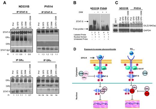 Figure 5. Both ND EBs exposed to excess glucocorticoids (by costimulation with erythropoietin and glucocorticoids) and PV EBs expressing the dominant negative GRβ isoform exhibit impaired functional GR/STAT-5 nuclear interaction. Erythroblasts were generated at day 10 of HEMA (Prol) and analyzed either as such or after growth factor deprivation for 4 hours (GFD) followed by treatment with erythropoietin (EPO; 3 U/mL) and dexamethasone (DXM; 10−6M), alone or in combination. (A) Erythroblasts obtained from 1 ND and 1 PV patient were immunoprecipitated (IP) with either STAT-5– or GRα-specific antibodies and the immunoprecipitations were analyzed by WB with either anti–STAT-5 or anti-GRα, as loading control, or with anti–STAT-5pY and anti-GRβ antibody. Similar results were obtained in 3 additional experiments, each with a separate donor. (B) EMSA with STAT-5–specific labeled probes of nuclear extract of EBs from 1 ND and 1 PV patient with (+) and without (−) DXM for 24 hours. Lane 1 is labeled probe only; lane 2, labeled probe with ND EBs without DXM; lane 3, labeled probe with ND EBs treated with DXM; lane 4, labeled probe with PV EBs treated with DXM; and lane 5, labeled probes with PV EBs that competed with excessive unlabeled probe. The position of the STAT-5–bound and –free probe is indicated by arrows. Similar results were obtained in 3 additional experiments. (C) WB analyses for GILZ and GAPDH (as loading control) expression of EBs generated at day 10 of HEMA (Prol) from ND or PV as indicated and analyzed either as such (Prol) or after growth factor deprivation for 4 hours (GFD) followed by treatment with erythropoietin (EPO; 3 U/mL) and DXM (10−6M), alone or in combination. Similar results were obtained in 3 additional experiments, each with a separate donor. Murine 293T cells overexpressing GILZ were analyzed as positive control. (D) Proposed model for development of erythrocytosis because of inhibition of GR/STAT-5 interactions by exposure to excess glucocorticoids and expression of the dominant negative GRβ isoform. In patients chronically stimulated with glucocorticoids who express GRα only, costimulation with erythropoietin and dexamethasone impairs regulation of GR/STAT-5–responsive genes by inhibiting STAT-5 phosphorylation and formation of GR/STAT-5 tetrameric complexes (A) and reducing the DNA-binding activity of STAT-5 (B). In PV, STAT-5 is constitutively phosphorylated by JAK2V617F (A) but cannot form complexes with GRα because this protein is largely retained in the nucleus as GRβ heterodimer (B). Therefore, in PV EBs, the DNA-binding activity is reduced (B), and expression of GR/STAT-5–responsive genes, such as GILZ, is also defective (C).