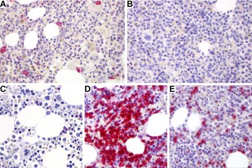 Figure 1. Plasma cells and T cells in BM biopsies of a control case and a CVID patient (patient 2 in Table 1). (A) Normal CD38+ plasma cells (red color) in a control biopsy. (B) Absence of CD38+ plasma cells in a typical CVID Ia BM biopsy. (C) Sparsely scattered CD3+ T cells in typical control biopsy in contrast to a nodular T-cell cluster (D) and diffuse interstitial T-cell infiltrates (E) in a representative CVID bone marrow biopsies. Immunostains: CD38 (A-B), original magnification ×200; and CD3 (C-E), original magnification ×200. Images were obtained with a Zeiss Axioskop 50 microscope equipped with a digital camera (3CCDColor Video Camera; Sony) using Cell P Imaging Software Version 3.3 (Olympus). The figure was finalized applying Adobe Photoshop CS2 Version 9.0. Original magnification 400× (Plan-Neofluar objective 40×/0.75; Zeiss).