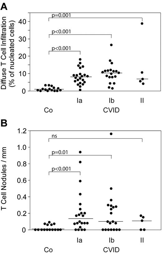Figure 2. T-cell infiltrates. Diffuse (A) and nodular T-cell infiltrates (B) in 47 BM biopsies from classified CVID patients and 15 controls (“Staining and evaluation of BM biopsies”). ns indicates not significant.