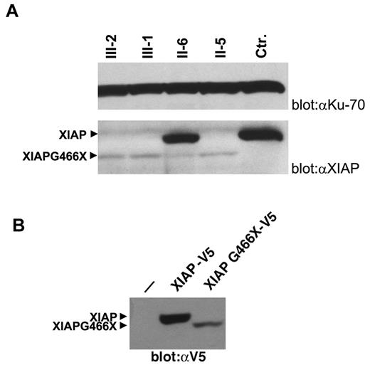 Figure 2. XIAPG466X protein expression. (A) Western blot analysis of XIAP and XIAPG466X protein expression. Lysates from PHA-expanded T-cell blasts derived from healthy control (Ctr.), male patients (III-2, III-1, and II-5), and a female carrier (II-6, sister of II-5) were immunoblotted with anti-XIAP antibodies and with anti-Ku70 antibodies as loading control. II-6 is a heterozygous carrier expressing both XIAP and XIAPG466X proteins. (B) Expression of V5-tagged forms of XIAP and XIAPG466X proteins in 293T cells. Total lysates were prepared 48 hours after transfection and immunoblotted with anti-V5 antibodies.