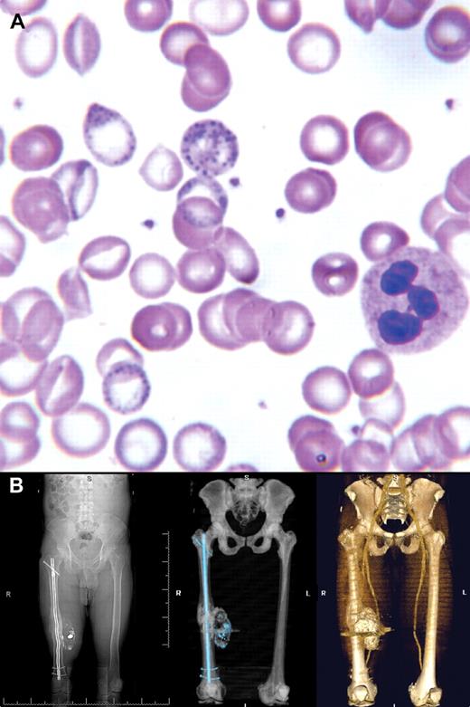 A 44-year-old male presented with chronic abdominal pain that prompted multiple previous hospitalizations with negative assessments. The patient had a past history of moderate alcohol consumption but none in the past 20 years. There was no occupational exposure. Laboratory tests showed microcytic anemia (hemoglobin 6.6 mg/dL, mean corpuscular volume 66.8 fL) with normal iron studies and basophilic stippling on the peripheral smear (panel A). Further history disclosed a retained bullet fragment in his right thigh 2 years previously. Radiographic views of his right thigh affirmed several metallic bullet fragments and posttraumatic soft tissue calcification and ossification. Computed tomography with 3-D reconstruction (panel B) showed a large calcified mass of the thigh, consistent with a complex hematoma. / Lead levels were as high as 306 μg/dL. The patient was started on intramuscular EDTA for chelation. The bullet fragments were surgically removed without complications and the patient was discharged on oral dimercaptosuccinic acid for 2 weeks. Currently, 3 years later, he is asymptomatic with a normal complete blood count (hemoglobin 14.4 g/dL, mean corpuscular volume 86.4 fL), undetectable lead levels, and subsequent peripheral smears that no longer demonstrate any basophilic stippling. / Basophilic stippling was the clue to the underlying diagnosis. Several reports have already described lead toxicity from retained bullets. (The orthopedic aspects of this case were previously reported in Dougherty PJ, van Holsbeeck M, Mayer TG, Garcia AJ, Najibi S. Lead toxicity associated with a gunshot-induced femoral fracture. A case report. J Bone Joint Surg Am. 2009;91(8):2002-2008.)