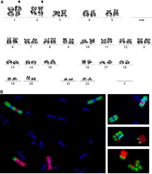 Figure 1. Cytogenetic aberrations in MSC N0806. (A) G-banding image demonstrates translocation of chromosomes 1 and 2 (arrows). (B) FISH with library probes for whole chromosomes 1 and 2 confirms that a fragment of 1p (green) is translocated to 2q (red) and part of 2q (red) is inserted into 1p (green).