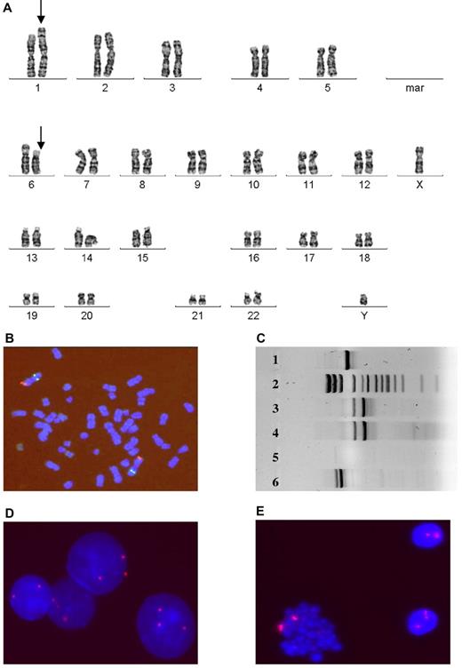 Figure 2. MSC (1282) demonstrates distinct aberrations compared with markers detected in HCs. (A) G-banding image shows translocation t(1;6)(p32;p12) (arrows) in MSCs. (B) FISH image with probes 1p36(red)/1q25(green) demonstrates the absence of this aberration in HCs. (C) RT-PCR for t(11;19)(q23;p13.3) demonstrates the aberration in HCs (lane 4), but not in MSCs (lane 5). Lane 3 is a positive control for the MLL-ENL fusion gene. Lanes 1 and 6 illustrate 2 alternative MLL-ENL fusion genes, and lane 2 displays the size standard. FISH image with CEP probes for chromosome 8 confirms trisomy 8 in HCs (D) and the absence of aberrations in MSCs (E).
