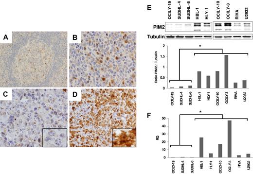 Figure 2. PIM2 expression in human DLBCL samples and cell lines. PIM2 immunohistochemical staining of reactive tonsil: original magnification (A) and 100× (B). IHC staining of DLBCL tissues: negative (C) and positive (D) PIM2 staining. Western blot analysis (E) and qRT-PCR (F) of PIM2, in a panel of DLBCL cell lines characteristics of GC or post-GC. The expression of PIM2 is significantly higher (t test, *P < .02) in cell lines of the ABC-DLBCL subtype. The levels of PIM2 were quantified from the Western blot using ImageJ 1.36b (National Institutes of Health) and normalized against α-tubulin. Data are representative of 2 independent experiments. RQ (2-ΔΔCT) was calculated using Universal Human Reference RNA (Stratagene) as the calibrator. RT-PCR reactions were performed in triplicate.