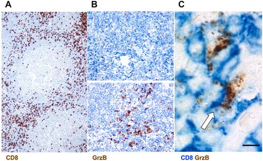 Figure 1. Infiltration of CD8+ GrzB+ cells in the interfollicular spaces of FL lymph nodes. (A) Representative section from FL lymph nodes of cells positive for CD8 as detected by IHC (original magnification ×200). (B) Examples of low (top panel) and high GrzB (bottom panel) staining (Original magnification, 400). (C) Double staining for CD8+GrzB+ cells. White arrow indicates double-positive cells (Original magnification, ×1000).