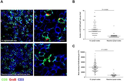 Figure 2. Accumulation of activated CTLs expressing high levels of GrzB in FL nodes as quantified by confocal laser scanning microscopy. Tissue sections from FL or reactive lymph nodes were stained for CD8 (green), CD3 (blue), and GrzB (red). (A) Representative staining of CD3+CD8+GrzB+ cells in FL (top panels) or reactive (bottom panels) lymph nodes (bar = 10 μm in left panels and 5 μm in right panels). (B) Scoring of CD3+CD8+GrzB+ cells in the interfollicular area of 10 FL and 5 reactive lymph nodes. More than 5 fields from each of the 10 FL and of the 5 control lymph nodes were randomly scored. Statistical significance of difference between groups was evaluated by a Wilcoxon-Mann-Whitney test using STATA Version 11; P = .0024. (C) Measurement of GrzB expression in CD3+CD8+ cells in the interfollicular area of 10 FL and 5 reactive lymph nodes. Measurements for GrzB fluorescence intensity were performed as described in “Confocal Image Quantification.” More than 5 fields from each of the 10 FL and of the 5 control lymph nodes were randomly scored. Statistical significance of difference between groups was evaluated by a Student t test using STATA Version 11; P < .0001.