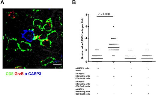 Figure 3. A significant fraction of a-CASP3+ cells is detected in contact with CD8+GrzB+ cells. Tissue sections from FL lymph nodes were stained for CD8 (green), a-CASP3 (blue) and GrzB (red). (A) Representative staining showing contact formation between CD8+GrzB+ cells and a-CASP3+ cells in a FL lymph node (bar = 5 μm). (B) Scoring of the total number of a-CASP3+ cells interacting with CD8+ or GrzB+ cells in 7 FL lymph nodes. The analysis was performed by scoring the fields using 3-D reconstructed images to unambiguously define cellular contacts (see “Confocal Image Quantification”). Statistical significance of difference between groups was evaluated by a paired Student t test using STATA Version 11; P = .0006.