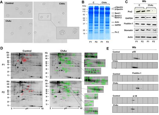 Figure 1. Proteomic analysis of RBC membrane fractions shows differences in ChAc compared with healthy controls. (A) Morphology of RBCs from control and ChAc subjects. (B-E) RBCs from control (C) and ChAc were fractionated in fraction 1 (F1) corresponding to a density < 1.074, containing reticulocytes, and fraction 2 (F2) corresponding to a density > 1.092, containing acanthocytes. (B) The fractionated RBC membrane proteins were separated by 1DE and stained with colloidal Coomassie blue. The bands that were identified by mass spectrometry are indicated: β-spectrin (accession no. P11277), 48% coverage; β-spectrin (accession no. P02549), 52% coverage; band 3 (accession no. P027330), 25% coverage; band 4.1R (accession no. P11171), 22% coverage; band 4.2 (accession no. P16452), 18% coverage; β-actin (accession no. P60709), 26% coverage; GAPDH (accession no. P04406), 18% coverage; and Prx-2 (accession no. P32119), 32% coverage. The figure shows a representative of 9 experiments performed with similar results. (C) Western blot (Wb) analysis of RBC membranes separated by 1DE with specific antibodies against Prx-2, GAPDH, flotillin-1, and stomatin proteins of fractionated RBCs from controls (C) and ChAc subjects. Actin was used as loading control. The data are representative for 8 experiments. (D-E) The membrane proteins of fractionated RBCs (see “Study design”) were separated by 2DE. Twin 2DE gels were run: one stained with colloidal Coomassie and the other transferred to membrane for Western blot analysis. (D) The colloidal Coomassie blue–stained gels underwent image analysis, and differently expressed proteins were identified by mass spectrometry (see “Comparative proteomic analysis”; supplemental Methods). Red and green spots indicated the differently expressed proteins based on image analysis. The identified proteins are reported in supplemental Table 2. The figures show 1 representative experiment from a total 8 experiments performed. (E) Western blot (Wb) analysis of the 2DE maps with specific anti–protein p55 antibody on F1 RBCs from control and ChAc subjects (validating the differently expressed spots 32C, 33C, and 34C in panel 1D and supplemental Table 2), anti–flotillin-1 antibody on F1 RBCs from control and ChAc subjects (validating the differently expressed spots 40C in panel D and supplemental Table 2), and anti–protein 4.1R antibody on F2 RBCs from control and ChAc subjects (validating the differently expressed spots 64C-68C in panel D and supplemental Table 2). The figures show one representative experiment of 3 experiments performed with similar results.