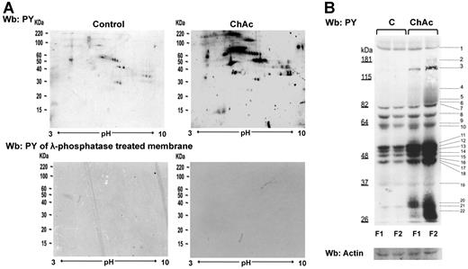 Figure 2. Tyr phosphorylation of RBC membrane protein is increased in ChAc compared with normal controls. RBCs from control (C) and ChAc subjects were fractionated as described in “Study design” and in the legend of Figure 1B-E. Western blot (Wb) analysis with specific anti–phosphotyrosine (PY) antibodies of RBC membrane proteins separated by either bidimensional electrophoresis (2DE) or monodimensional electrophoresis (1DE). (A) Twin 2DE gels were run: one used for colloidal Coomassie-stained gels (Figure 1D) and the other for the Western blot analysis with specific anti–phosphotyrosine (PY) antibodies. Top panel: Membranes of high-density RBC fraction (F2) from control (C) and ChAc subjects. Similar results were also obtained in low-density RBC fraction (F1) from control and ChAc (data not shown). Bottom panel: Dephosphorylation of blotted proteins by recombinant λ protein phosphatase (400 U/mL). The blotted membranes were incubated in TBS containing 1% BSA, 0.1% Triton X-100, 2mM MnCl2 (overnight at 4°C), and then probed with anti–phosphotyrosine antibodies. The data are representative for 3 experiments with similar results. (B) 1DE gels (13 cm) were blotted for Western blot (Wb) analysis with specific anti–phosphotyrosine (PY) antibodies. The bands with different staining intensities were identified by mass spectrometry (Table 2; “Comparative proteomic analysis”; supplemental Methods). Actin was used as a loading control. The data are representative of 8 experiments. See also supplemental Figure 1B for densitometric analysis of the Tyr phosphorylation profile of the RBC membrane proteins.