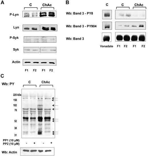 Figure 3. ChAc RBCs show increased Lyn Tyr kinase associated with the membrane. RBCs from control (C) and ChAc were fractionated as described in “Study design” and in the legend of Figure 1B-E. (A) Western blot analysis with specific antibodies of membrane-associated Tyr kinase Lyn and phospho-Lyn (p-Lyn), Syk, and phospho-Syk (p-Syk). Actin was used as a loading control. Shown is a representative of 6 experiments. Vertical line(s) have been inserted to indicate a repositioned gel lane. (B) Western blot (Wb) analysis with specific antibodies against Tyr-8 on the N-terminal of band 3, as a Syk target, and Tyr-904 on the transmembrane domain of band 3 (as a Lyn target). We used normal RBCs treated with Na-vanadate (see “Study design”) as positive controls. Total band 3 was used as loading control. (C) Western blot (Wb) analysis with specific anti–phosphotyrosine (PY) antibodies of high-density fraction (F2) of RBCs from control (C) and ChAc subjects are shown. The F2 RBCs were incubated with or without the Src family kinase inhibitors PP1 (10μM) and PP2 (10μM) as previously reported.19 The arrows indicated the bands affected by PP1-PP2 treatment in ChAc RBCs compared with untreated ChAc RBCs. The data are representative of 3 experiments (on 6-cm gels). Actin was used as a loading control. The data are representative of 3 experiments. Similar results were also obtained with cells from low density fraction (F1) control and ChAc RBCs (data not shown).