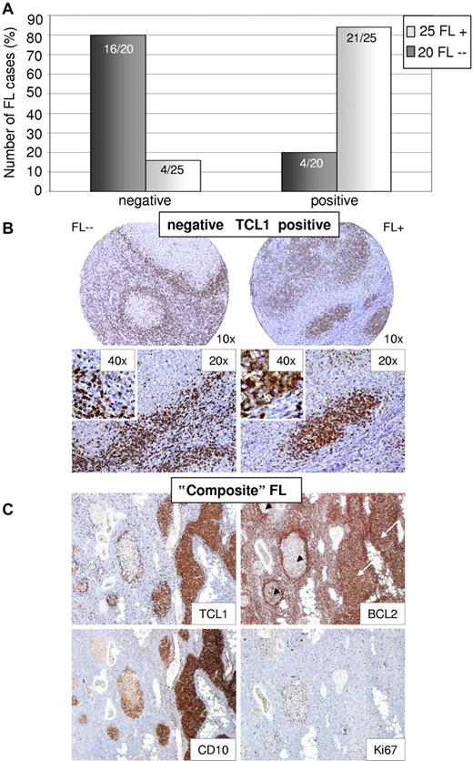 Figure 5. Differential expression of TCL1 between t(14;18)–negative and BCL2-negative (FL--) and t(14;18)–positive FLs (FL+) as detected by immunohistochemistry. (A) TCL1 is absent in 80% of t(14;18)–negative FLs without BCL2 expression, whereas it is present in 84% of t(14;18)–positive FLs as shown by immunohistochemistry (P < .0001, Fisher Exact). (B) Representative stainings for TCL1 in FL+ and FL--. (C) “Composite” FL with BCL2-positive (white arrows) and BCL2-negative/BCL2-weak (black arrowheads) atypical follicles. Atypical follicles with BCL2 expression stain positive for TCL1, whereas in BCL2-negative follicles TCL1 expression is absent. Of note, BCL2-negative atypical follicles showed decreased CD10 expression and elevated proliferation (Ki67) compared with BCL2-positive atypical follicles. Images were captured using a Olympus, Color View, BX50 microscope, the Color View digital camera, and the analysis work soft imaging system (all Olympus).